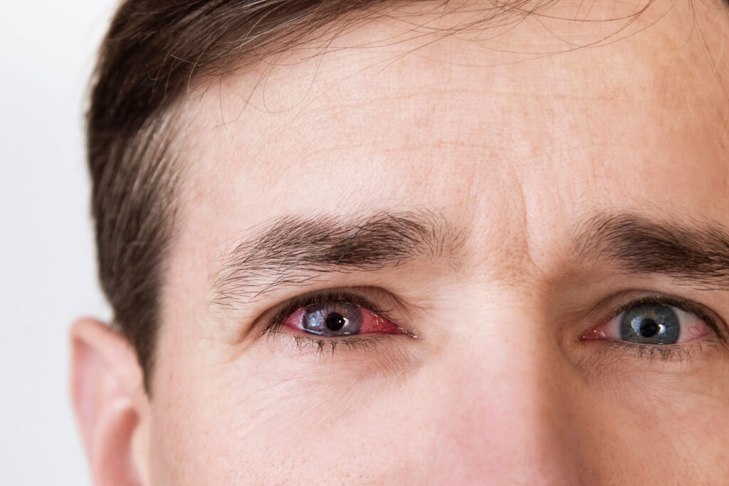 a man has bloodshot eyes due to long term meth abuse